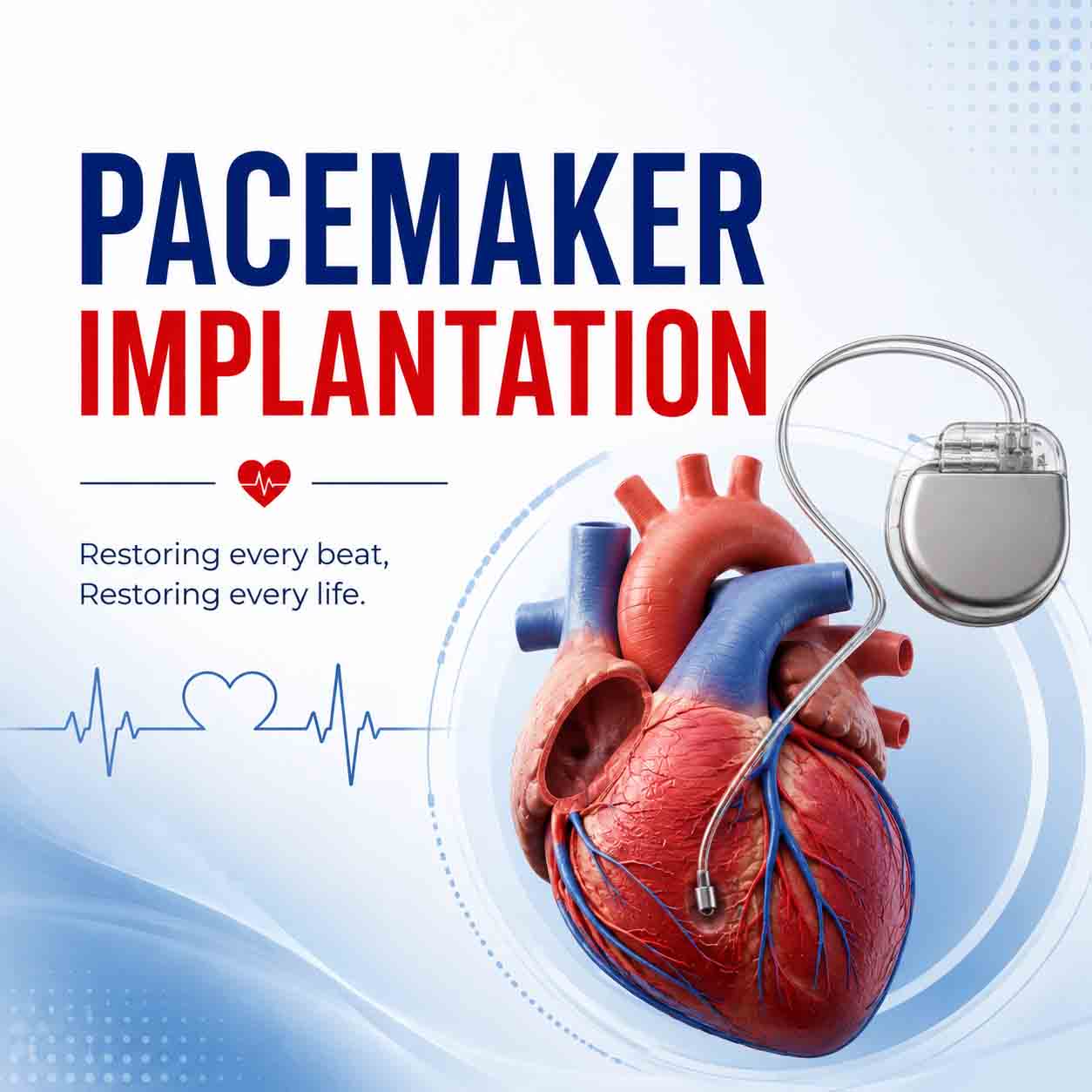 pacemaker implantation in delhi