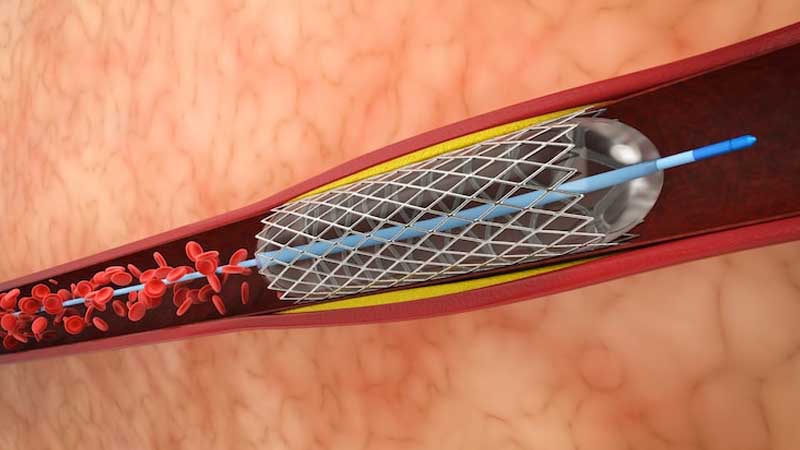 peripheral-angioplasty-delhi